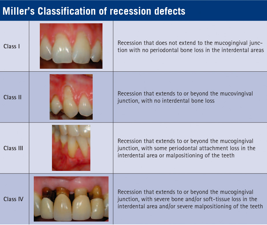 miller's-recession-defects